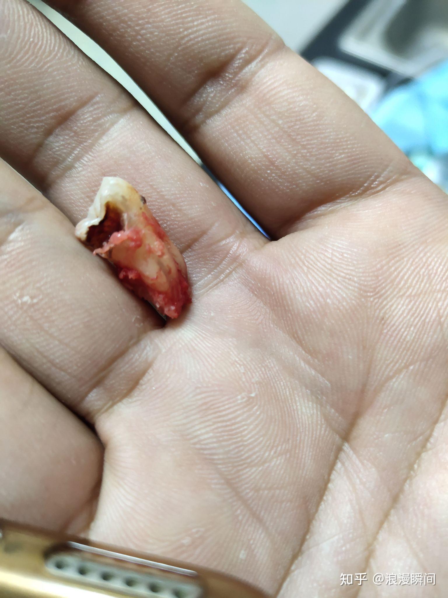 拔完智齿后的第几天才可以不疼啊