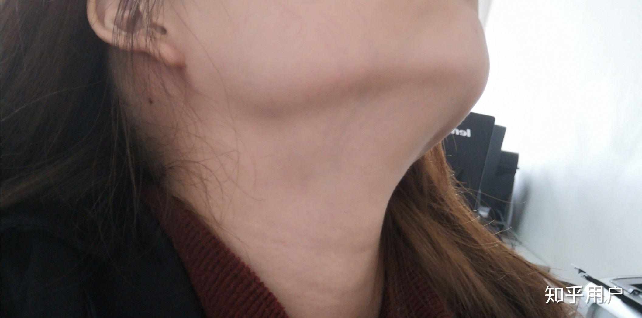 下巴和脖子连在一起了怎么办? - 知乎