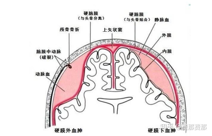 硬膜下血肿是怎么回事? - 知乎