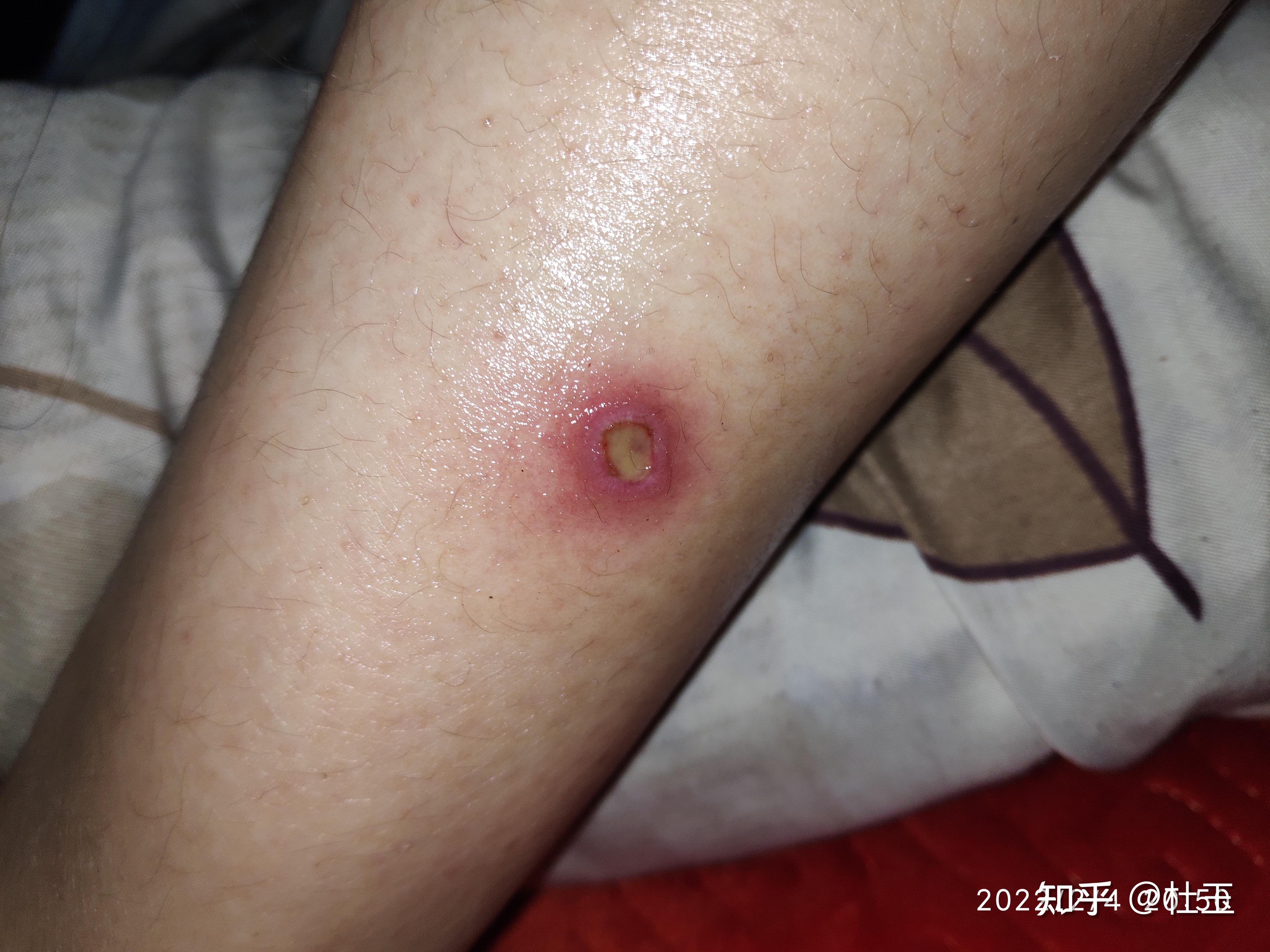 伤口没好,沾水,发白的物质是什么? - 知乎