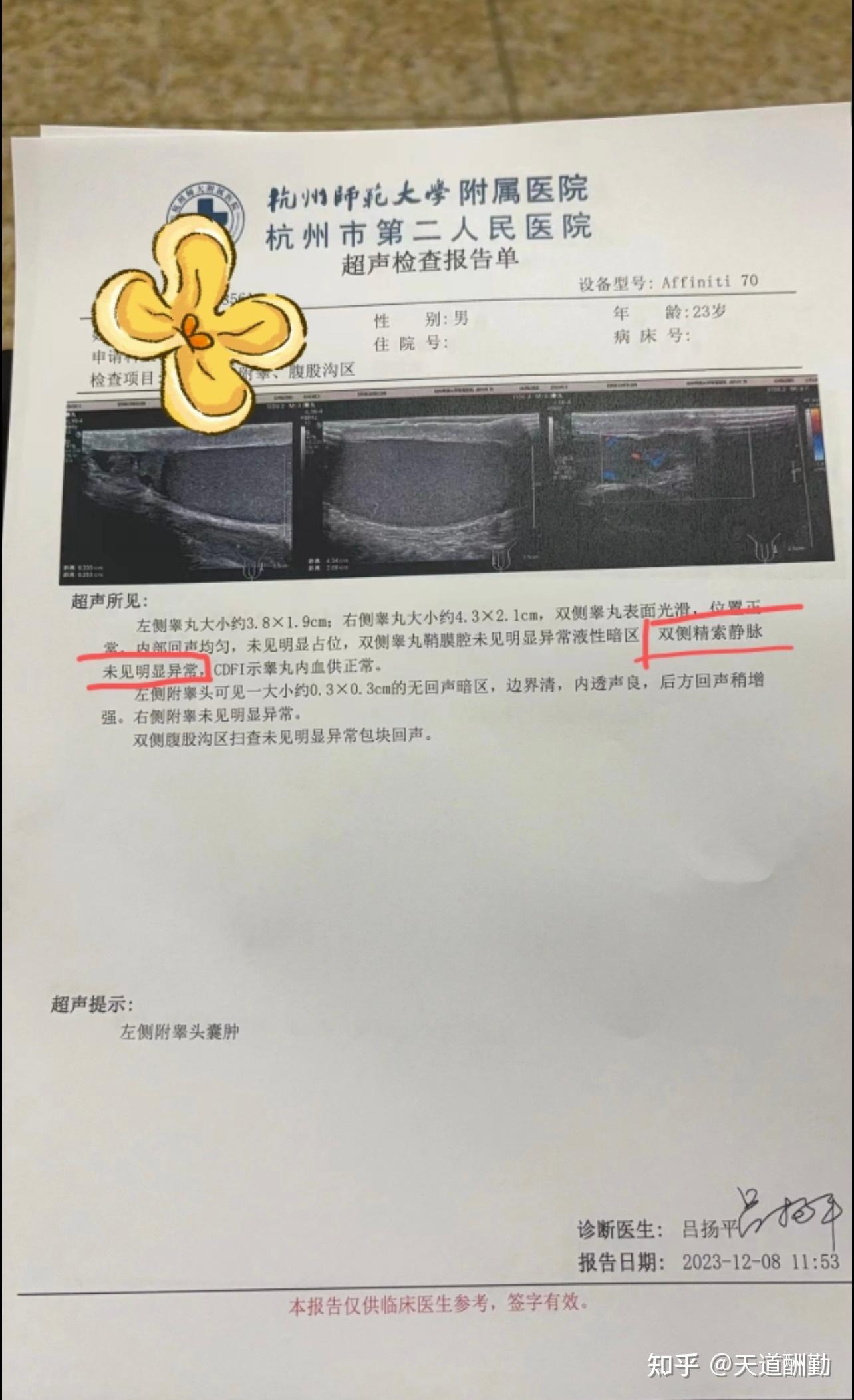 单侧精索静脉曲张痊愈心得