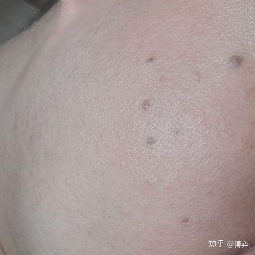 北京去痦子祛痣经验分享 - 知乎