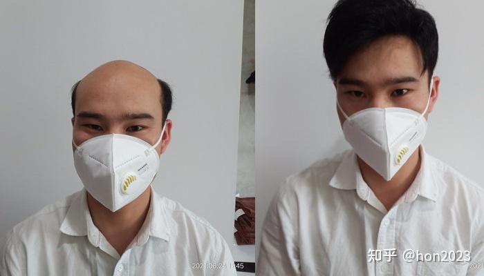 怎么能增加发量? - 知乎