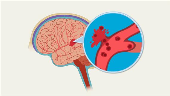 什麼是腦出血腦出血不同發病部位的不同症狀表現