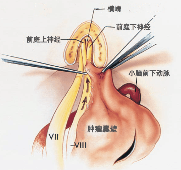 听神经瘤解剖---Rhoton解剖文献学习笔记系列 - 知乎