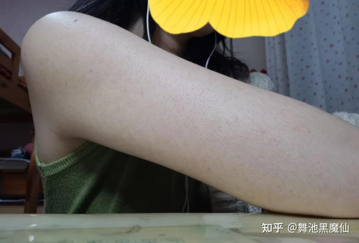 有腿毛的人没有鸡皮肤(腿毛长出来了是不是鸡皮肤就好了)