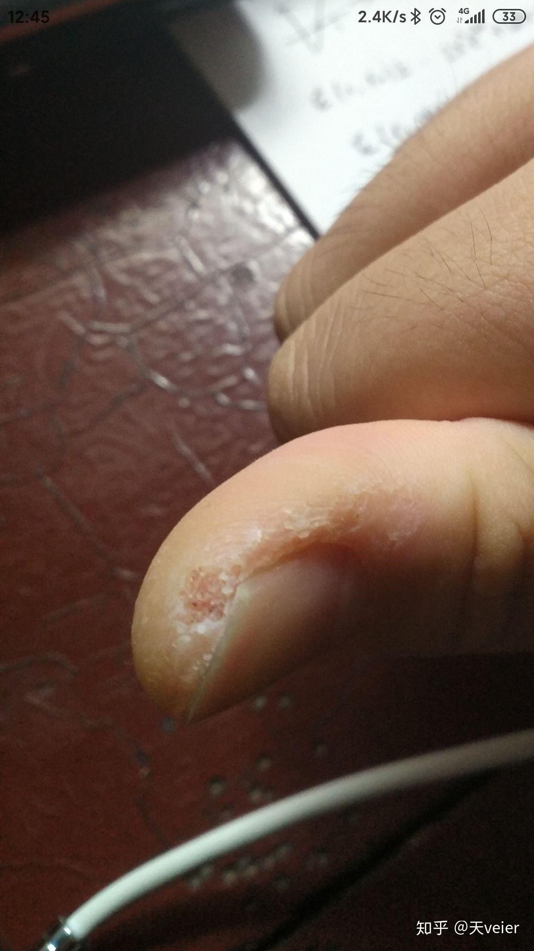 甲下寻常疣做液氮冷冻疼哭了可耐受疼痛真的这么厉害吗还是我太弱了