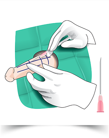 玻尿酸注射阴茎增粗手术怎么做?效果如何?