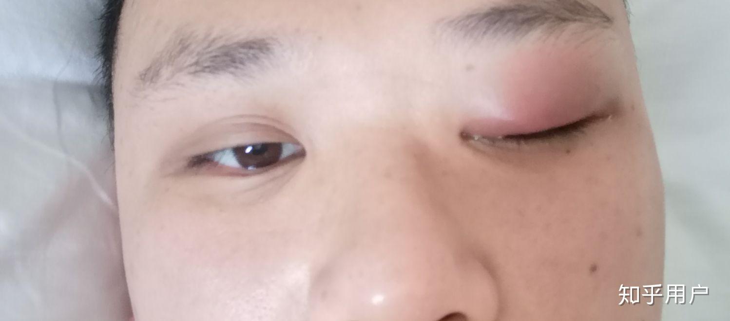 手指缠线是否对麦粒肿有疗效