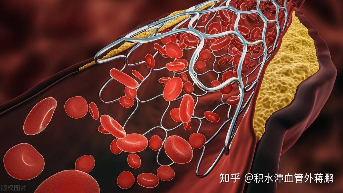 血管装支架到底好不好 - 知乎