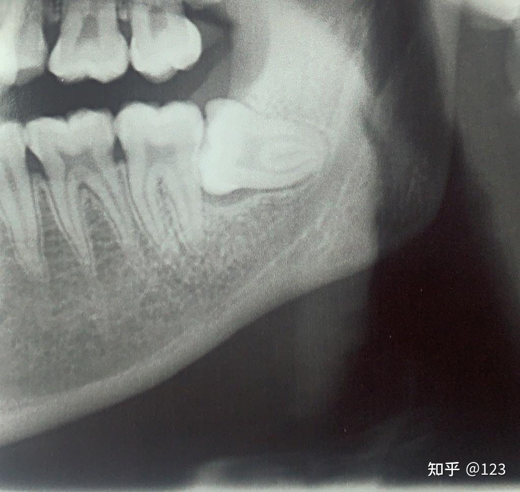 水平下頜低位阻生智齒不疼能不拔嗎