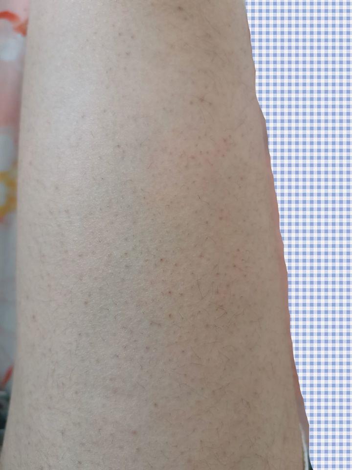 搓澡可以处理鸡皮肤吗(用澡巾使劲搓可以去鸡皮肤吗)