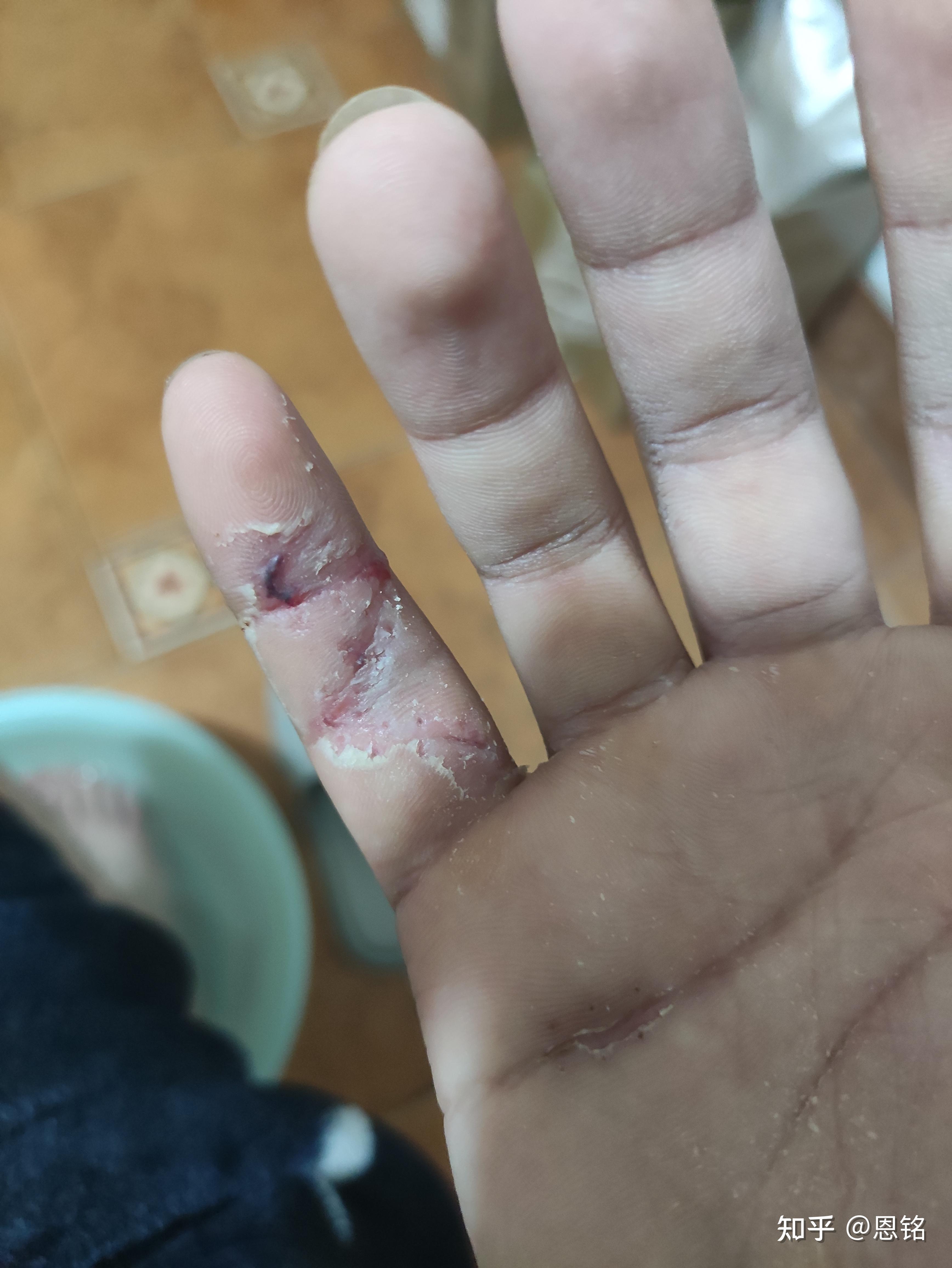 手指肌腱断裂最后一节无法伸直医生教我不要治疗了请问我该怎么做不