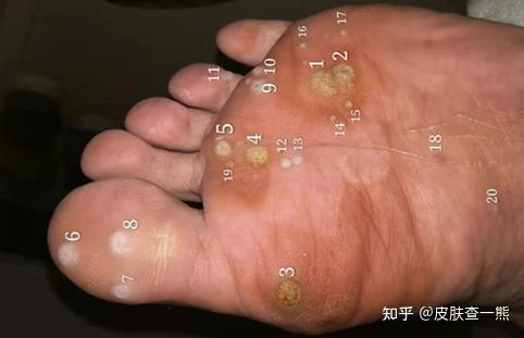 跖疣的自愈性大吗? - 知乎