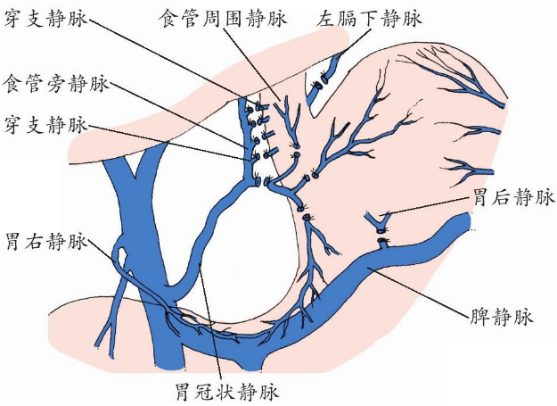 门脉高压症是什么病?需要手术治疗吗? - 知乎
