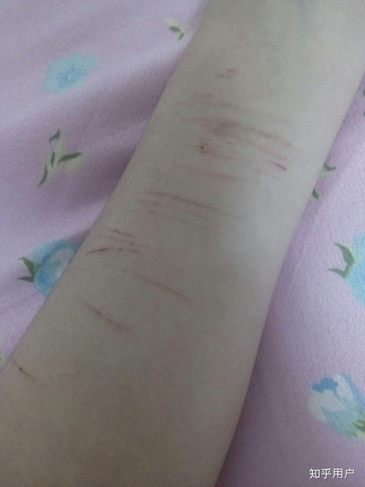 为什么抑郁症患者总选择割腕的方式自残? - 知乎