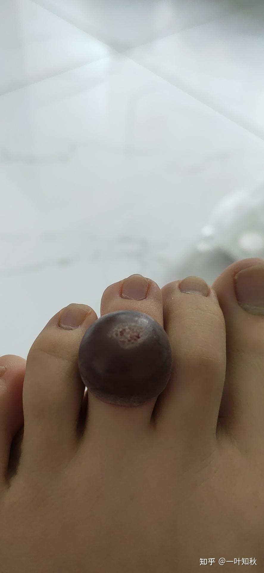 液氮冷冻治疗后手指上出了血泡而且越来越大该怎么办? - 知乎