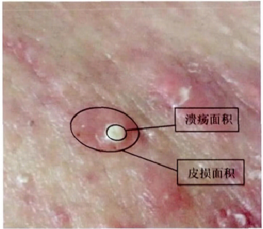 开口闭口型粉刺怎么办?