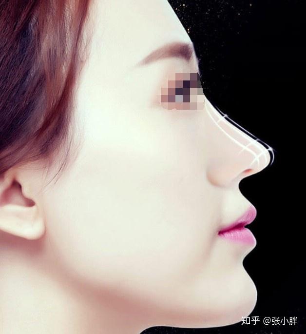 有没有隆鼻成功的小姐姐分享一下经验