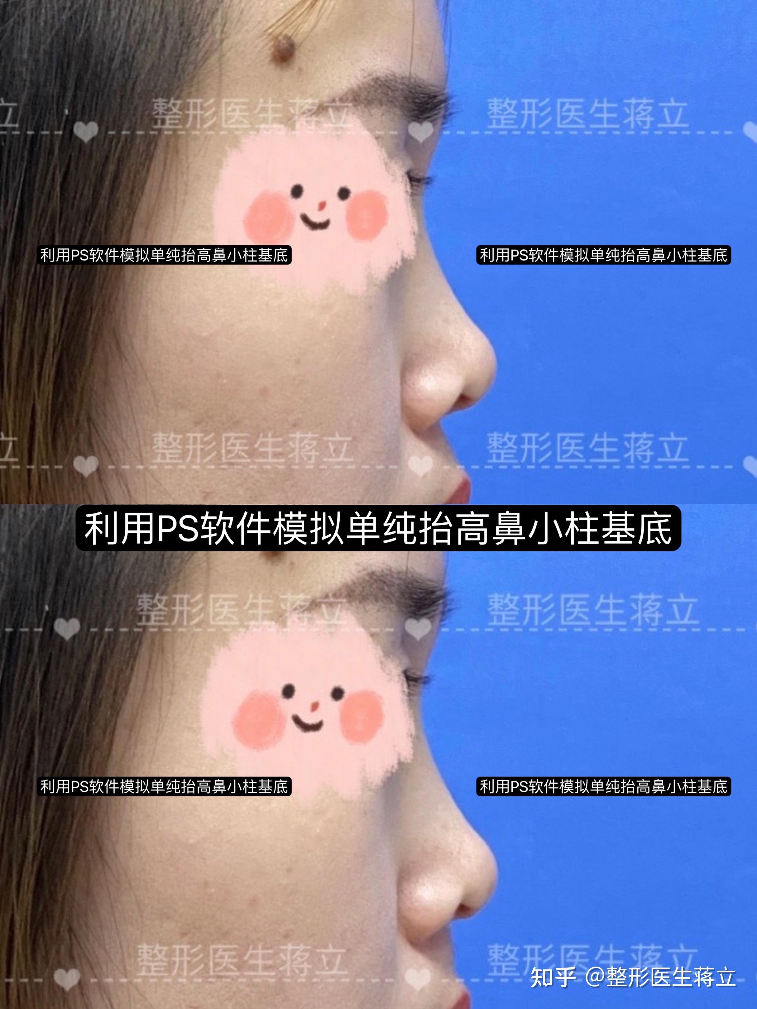 鼻头鼻翼缩小,鼻小柱延长,垫鼻基底做这三项鼻综合的费用大概是多少?