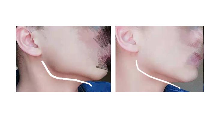 请问下颌骨严重不对称怎么办? - 知乎