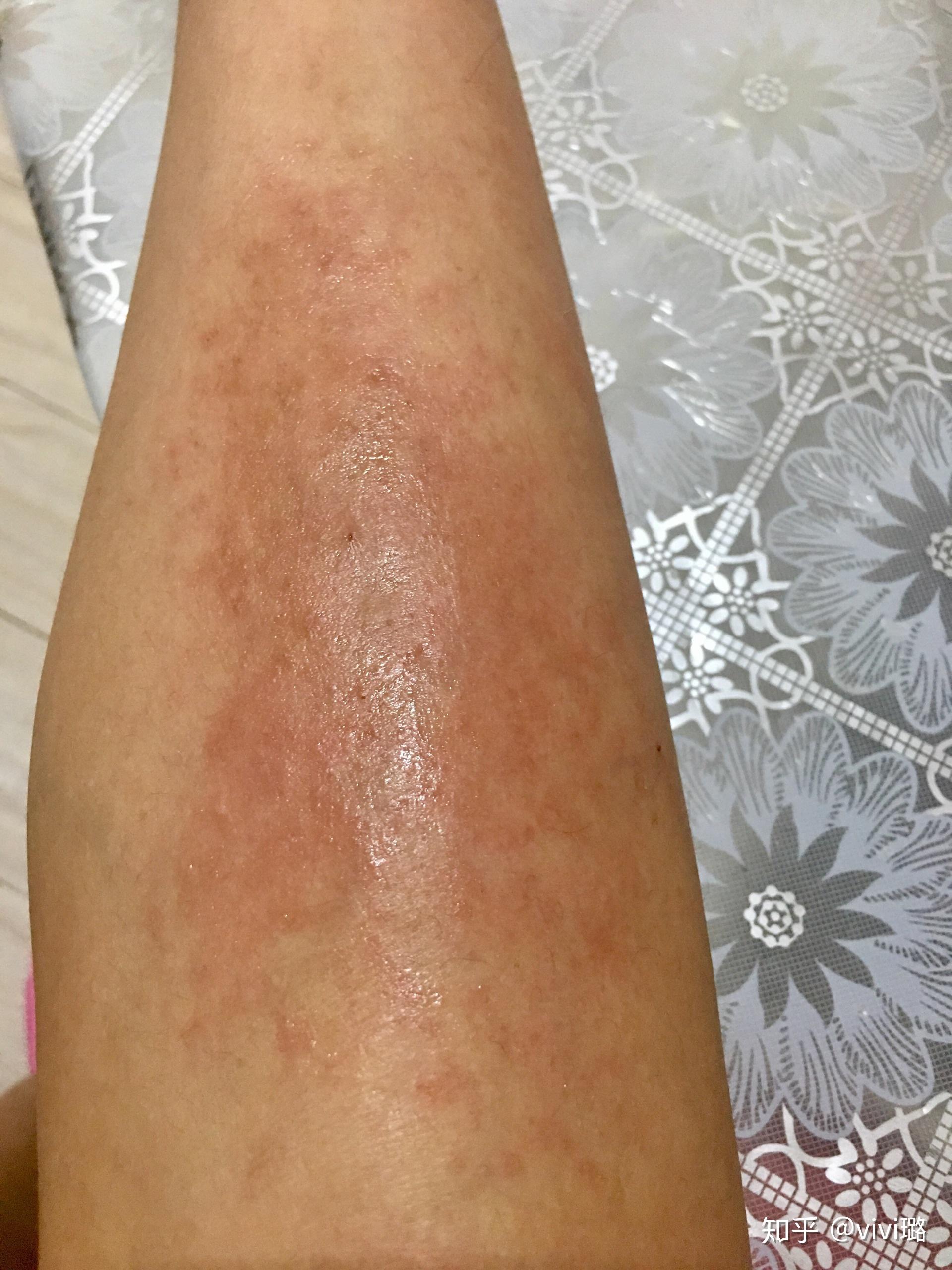 求助这是湿疹嘛越抓越痒越挠面积越大