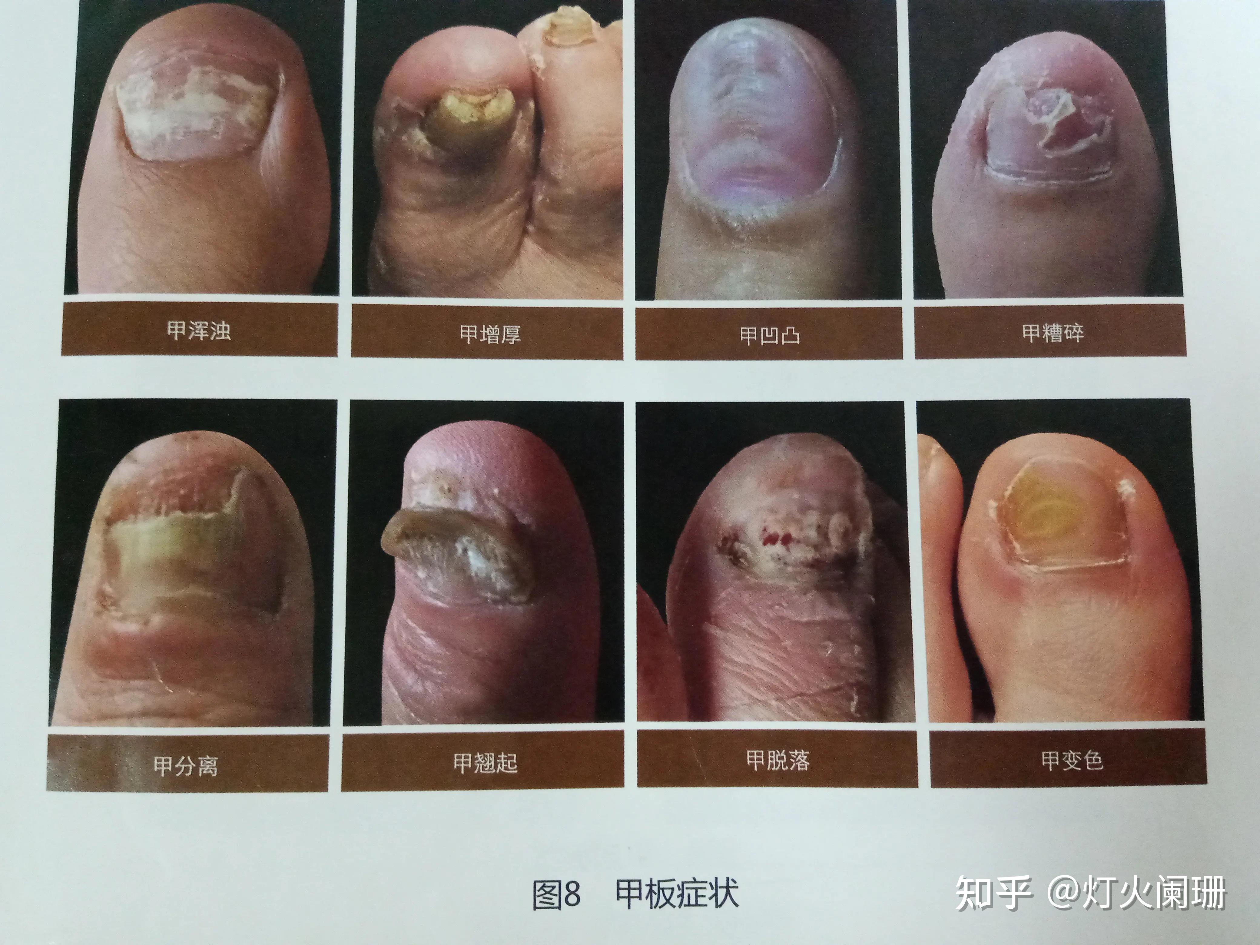 手上的灰指甲怎么治才能除根? - 知乎