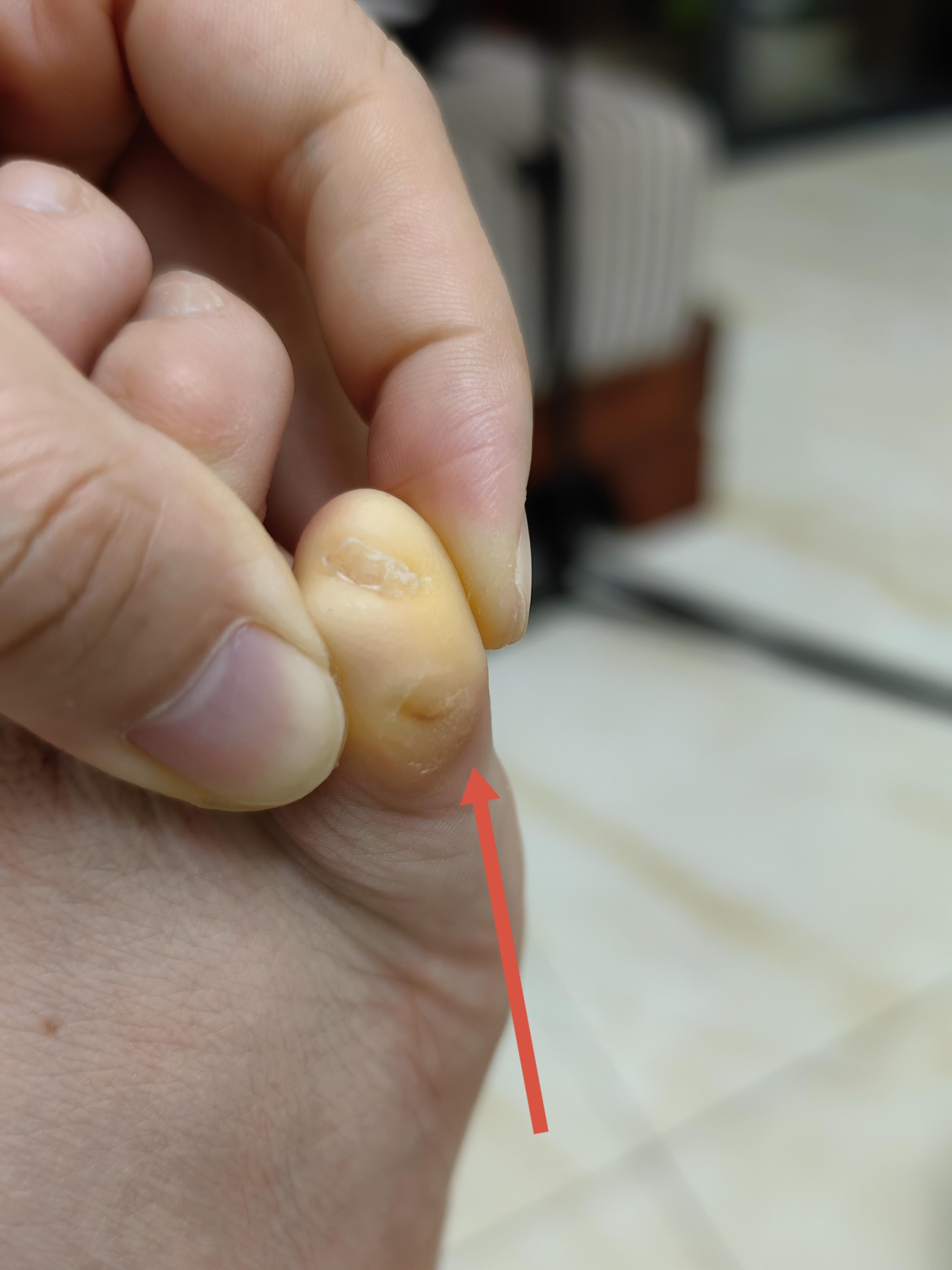 右脚【小脚指】疼