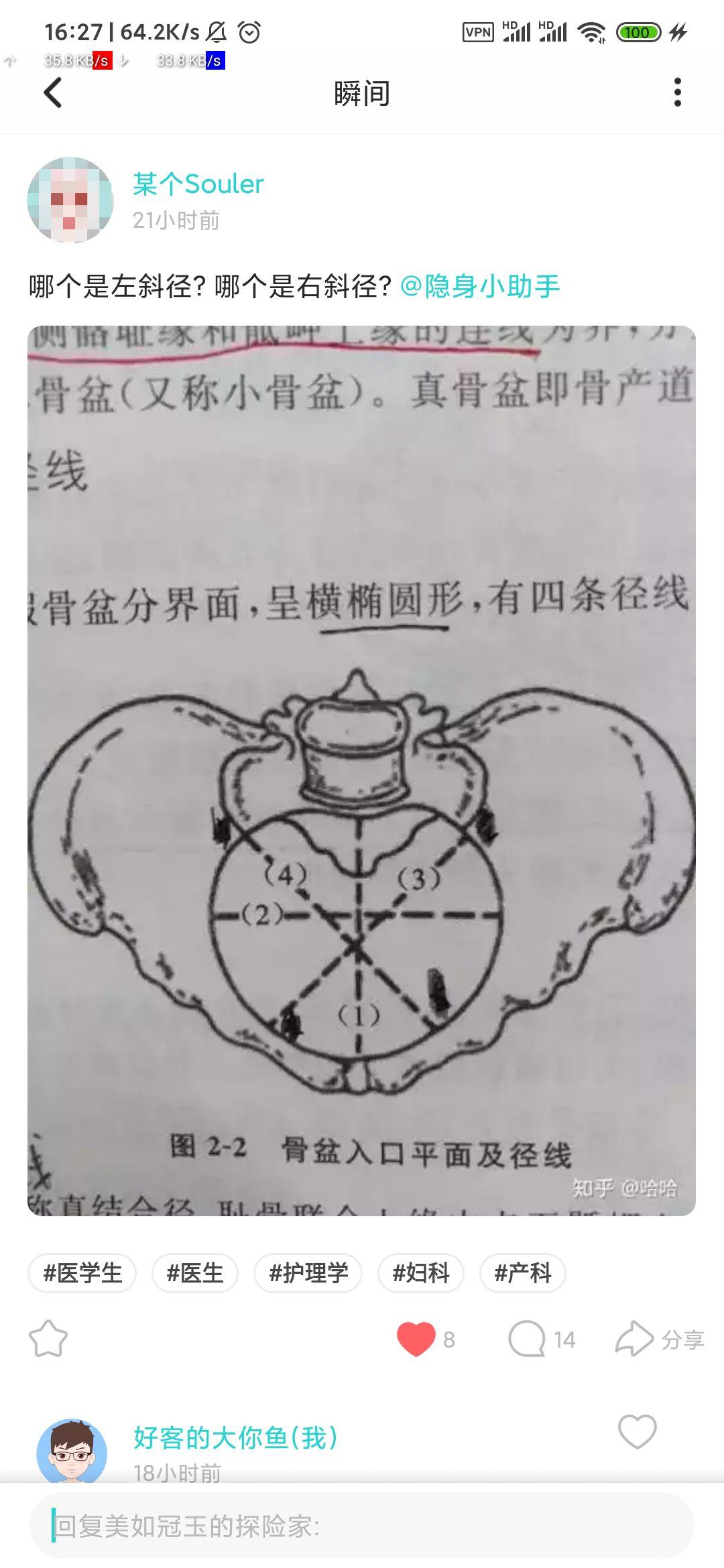 骨盆入口斜径怎么区分左右斜径哪条线是左斜径哪条线是右斜径