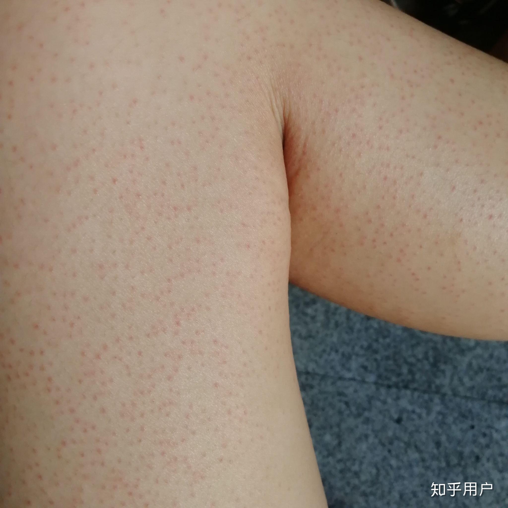 有姐妹用理肤泉大哥大防晒过敏的吗? - 知乎