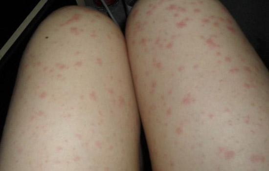 大腿毛囊炎怎么护理?