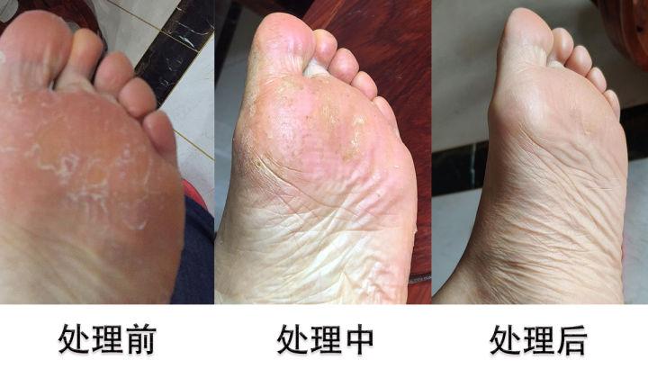 脚气反复发作的原因有哪些? - 知乎