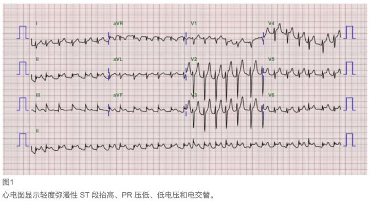 急性心包积液心电图图片