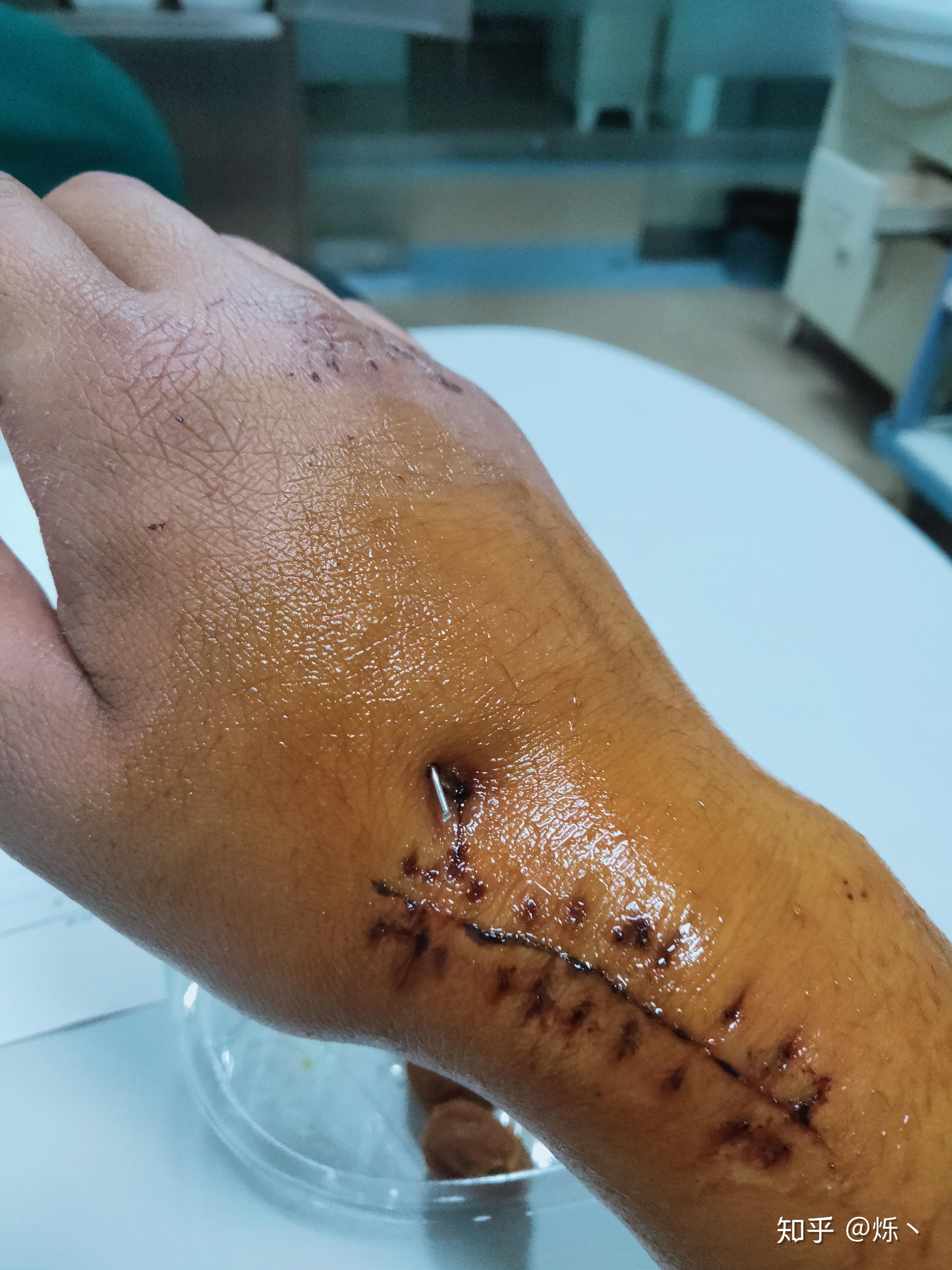 克氏针固定是一种什么体验,一般多久恢复? - 知乎