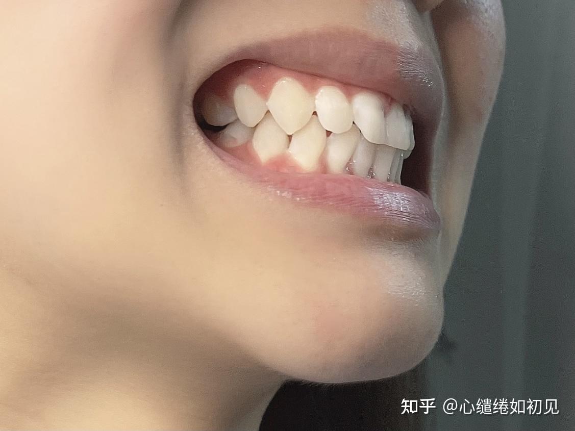 牙齿深覆合需要去做正畸吗? - 知乎
