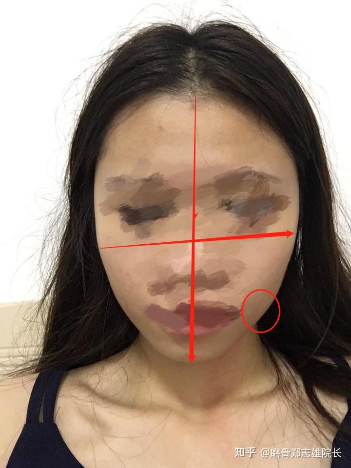 颧骨不对称 左右脸高低不一样 想问问我这是什么情况如何改善? - 知乎