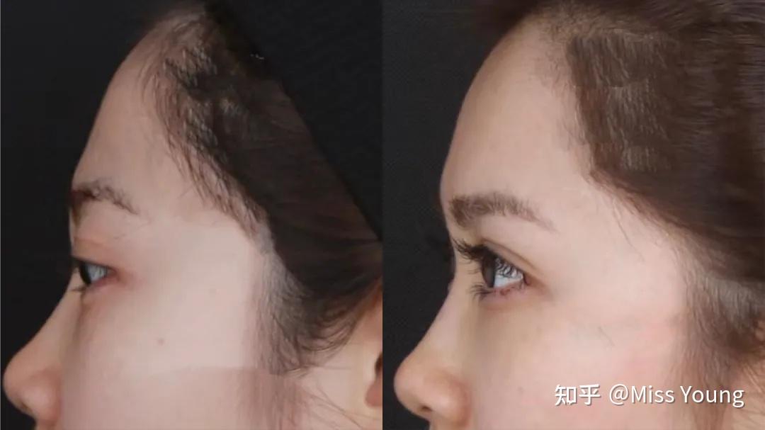 眼睛太凸怎么办?