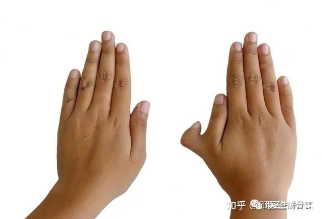 六指琴魔、断指轩辕、九指神丐——多指和断指畸形 - 知乎