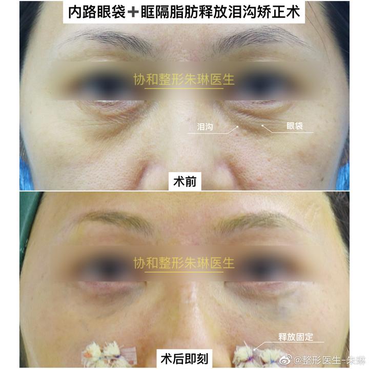 北京内路眼袋 眶隔脂肪释放泪沟矫正术。 - 知乎