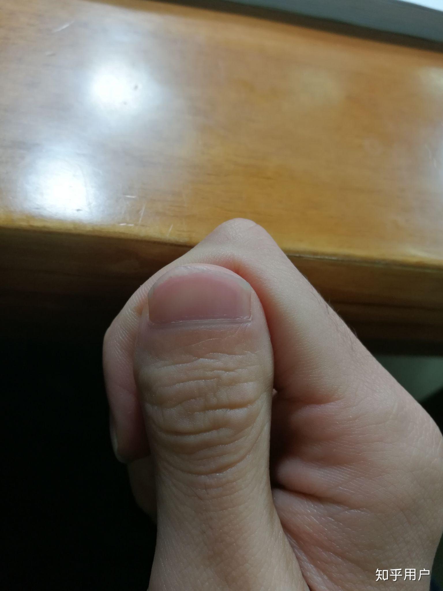 有些人的大拇指比较短粗指甲宽平或单侧或双侧这个性状是哪一个基因的
