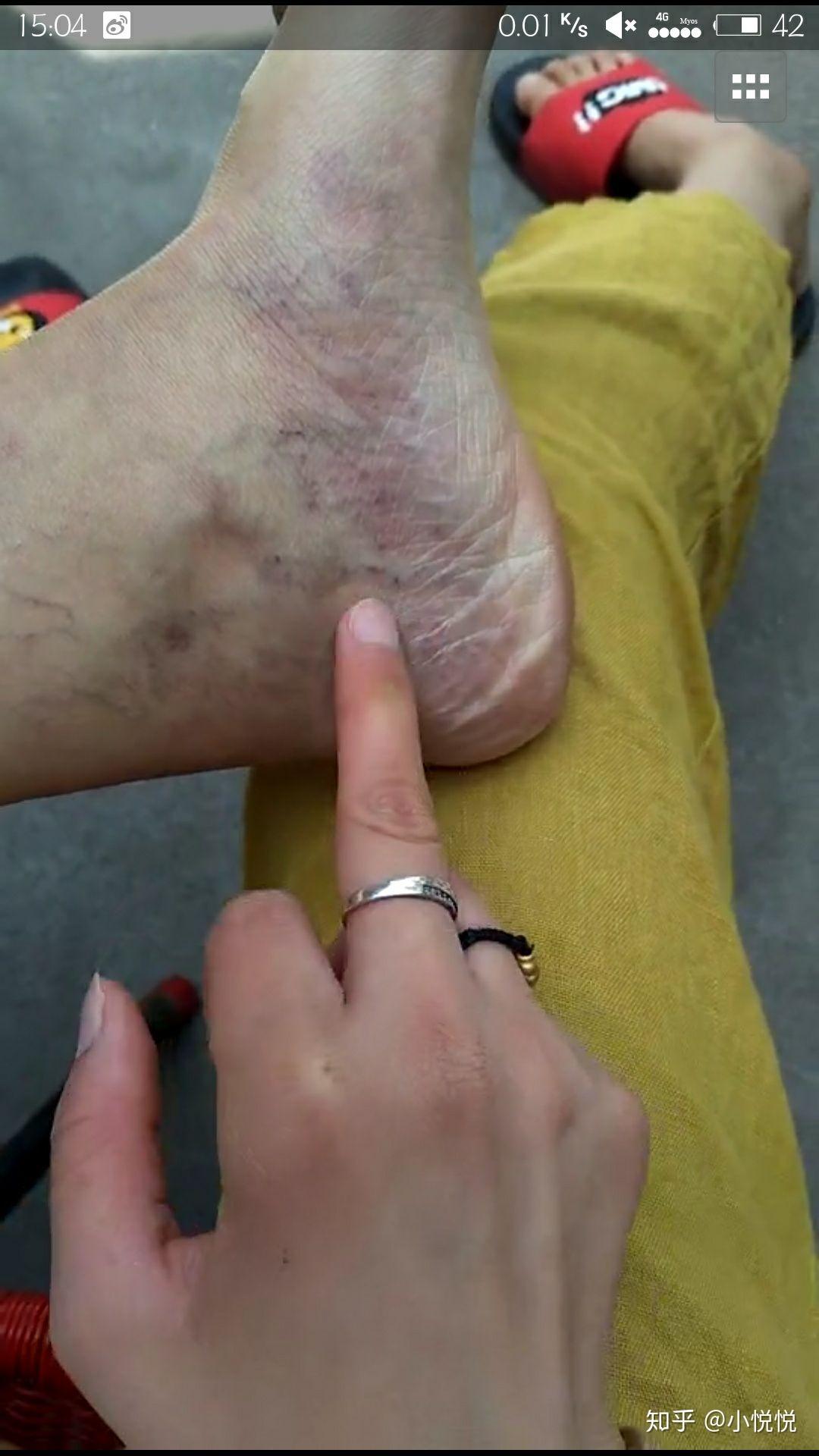 今年23岁各位可以帮我看看在大腿这是毛细血管扩张吗或是静脉曲张