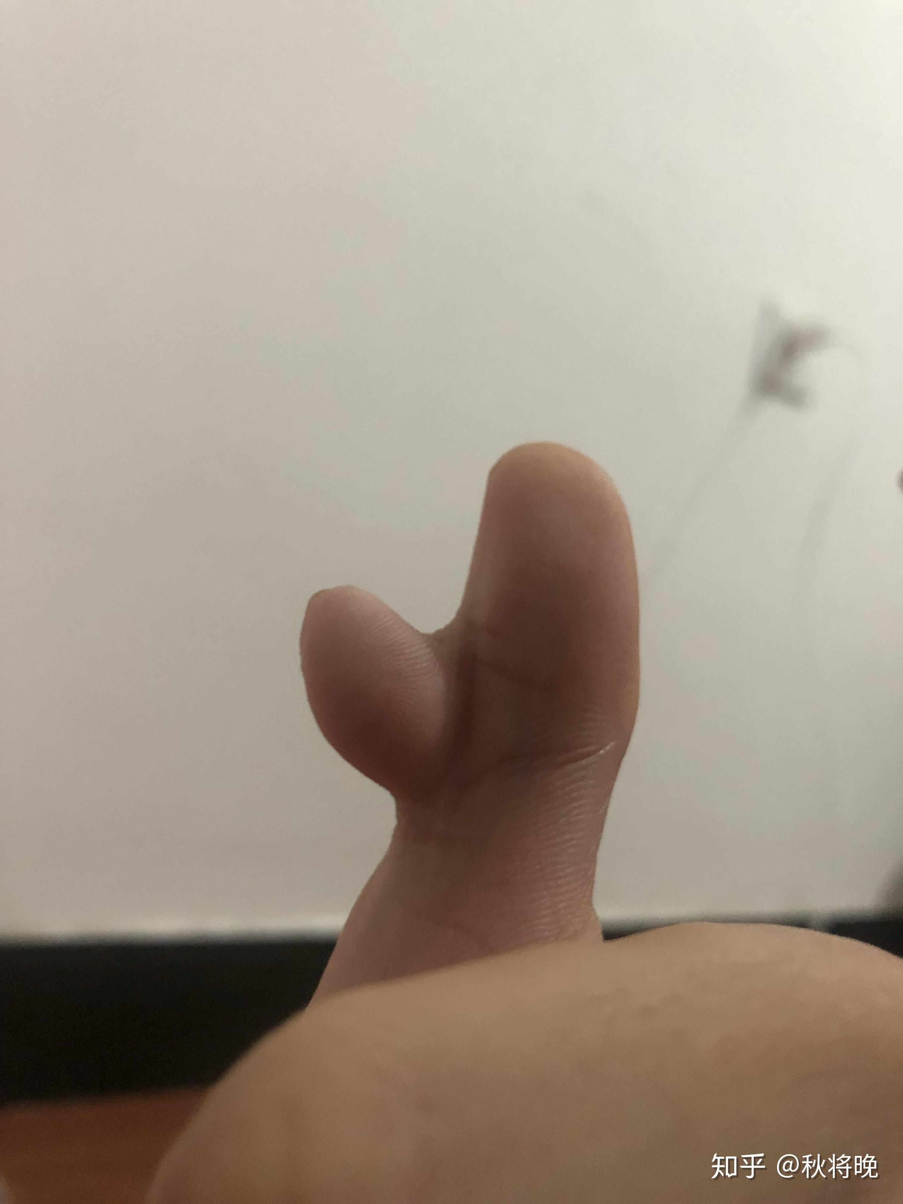 一只手有六个手指是种怎样的体验