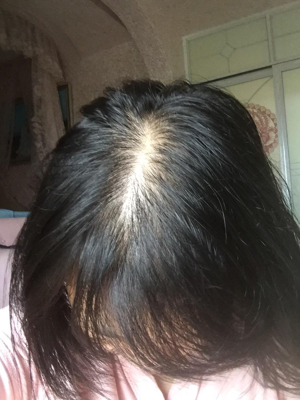 女生头顶头发少是什么体验