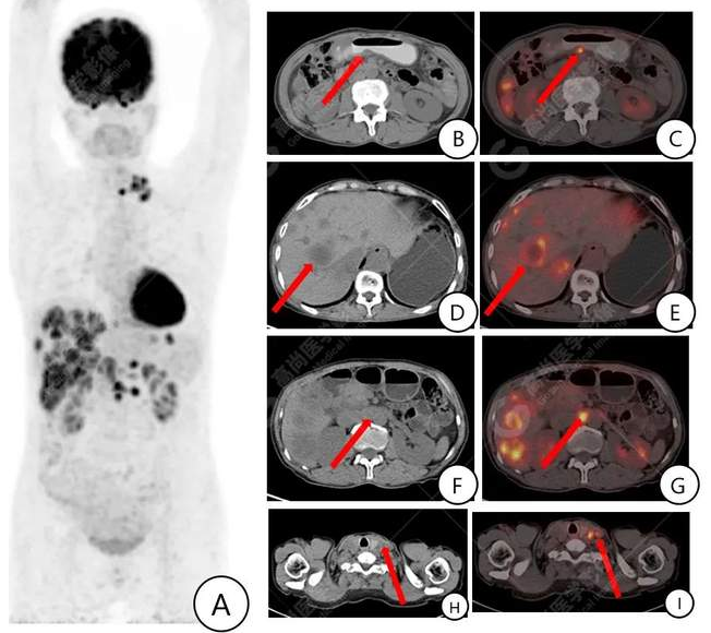 胃肝样腺癌，胃癌，肝癌？PET/CT找“真凶”「武汉高尚医学影像」 - 知乎