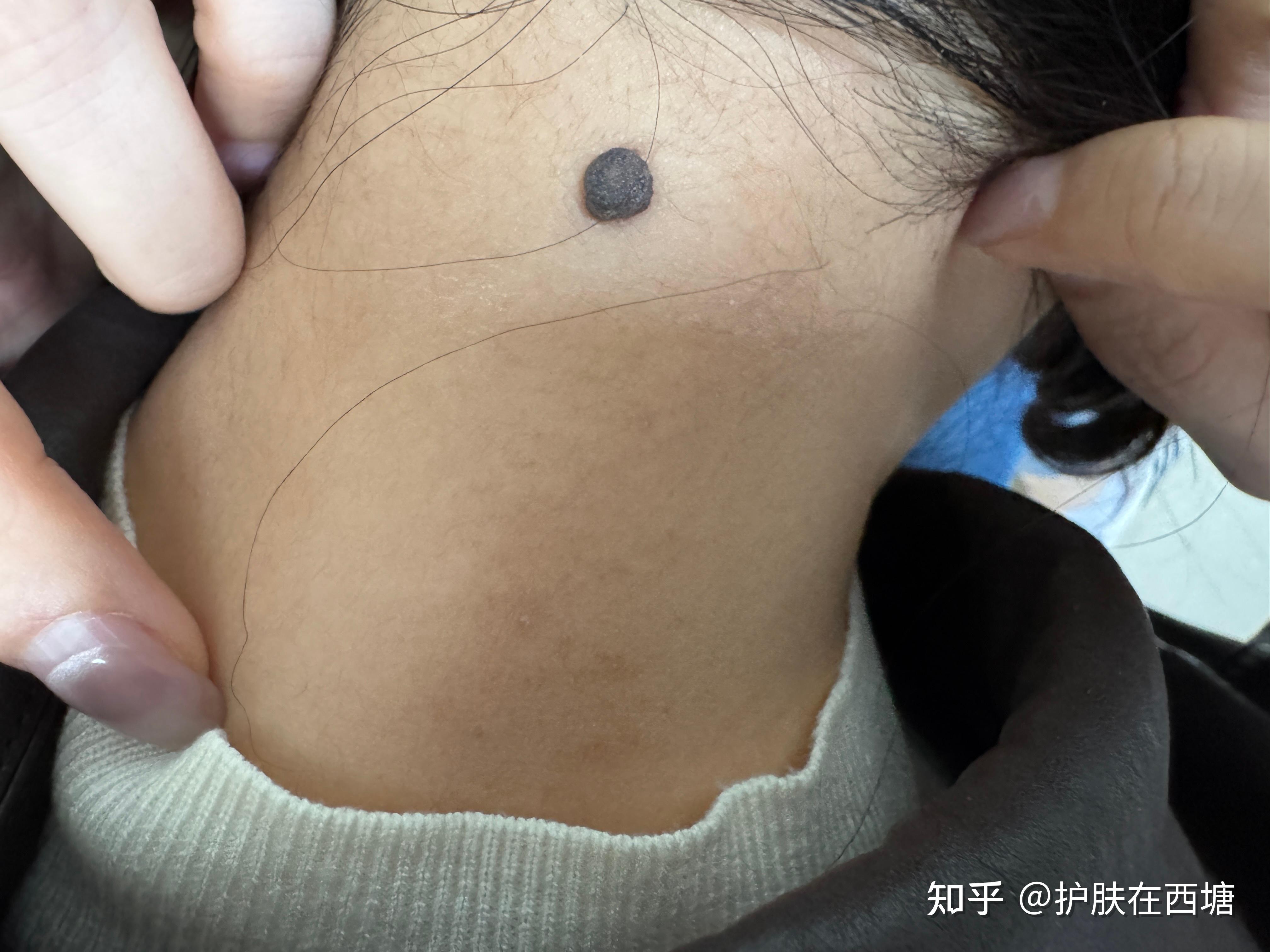 这颗痣是正常的嘛身上的痣一直比较多
