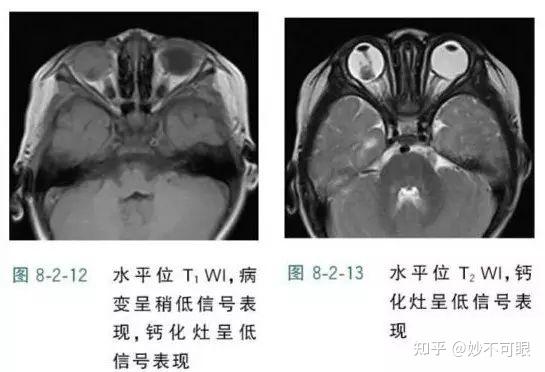 “眼癌”——可怕的儿童恶性肿瘤！ - 知乎