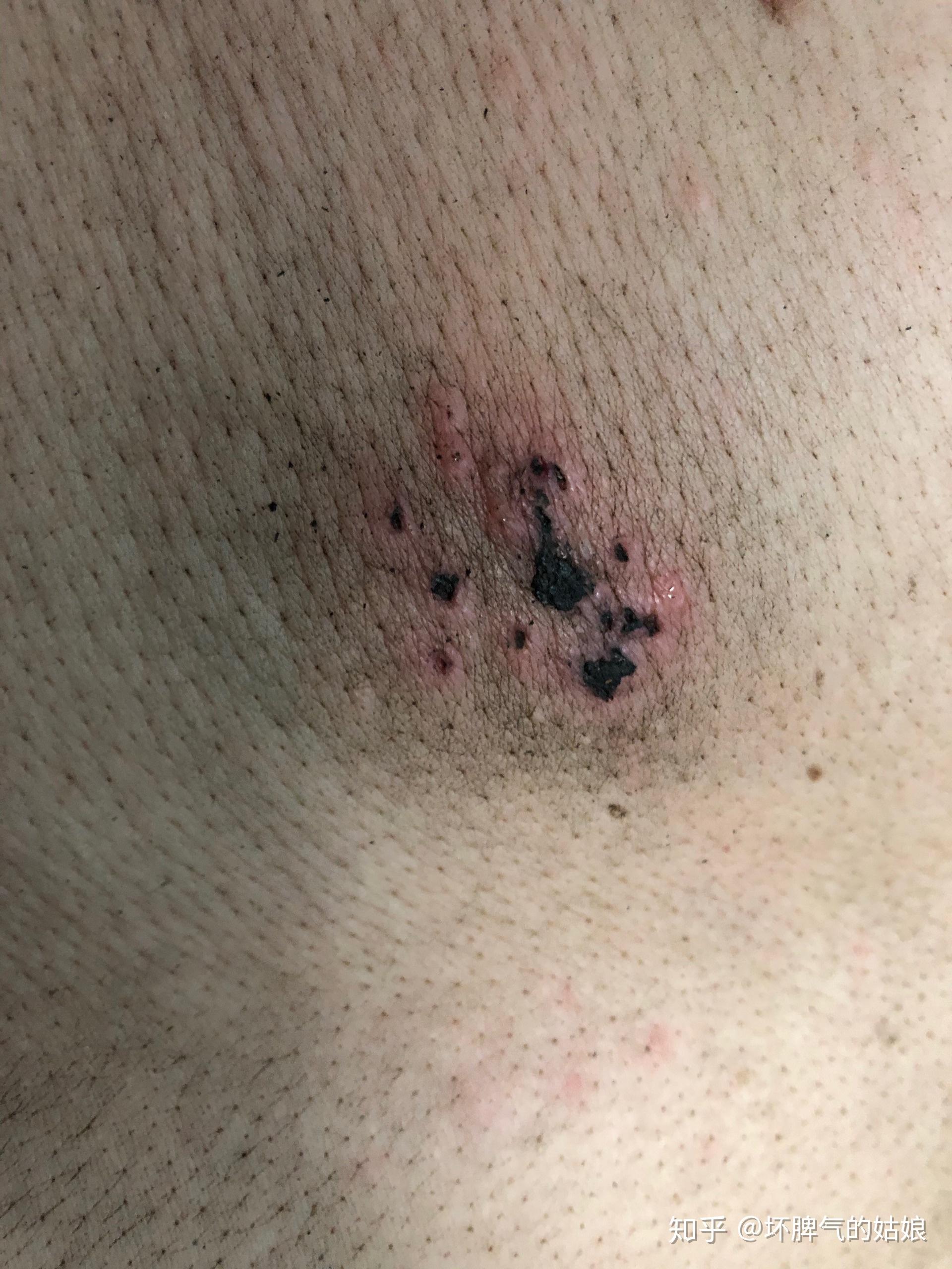 为什么大家患蛇胆疮迷信民间方法,不去医院治疗? - 知乎