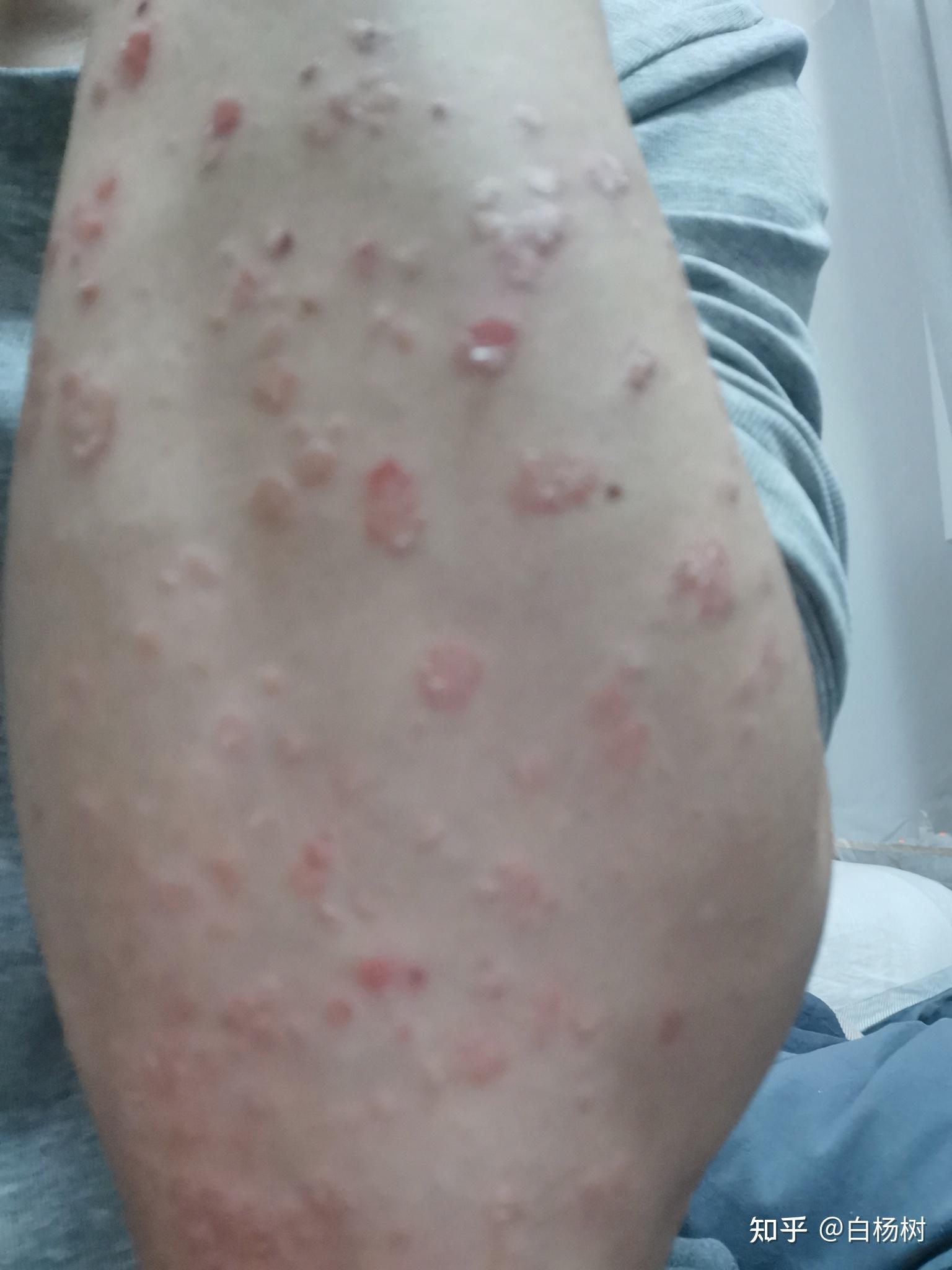 记录一下注射可善挺后的效果