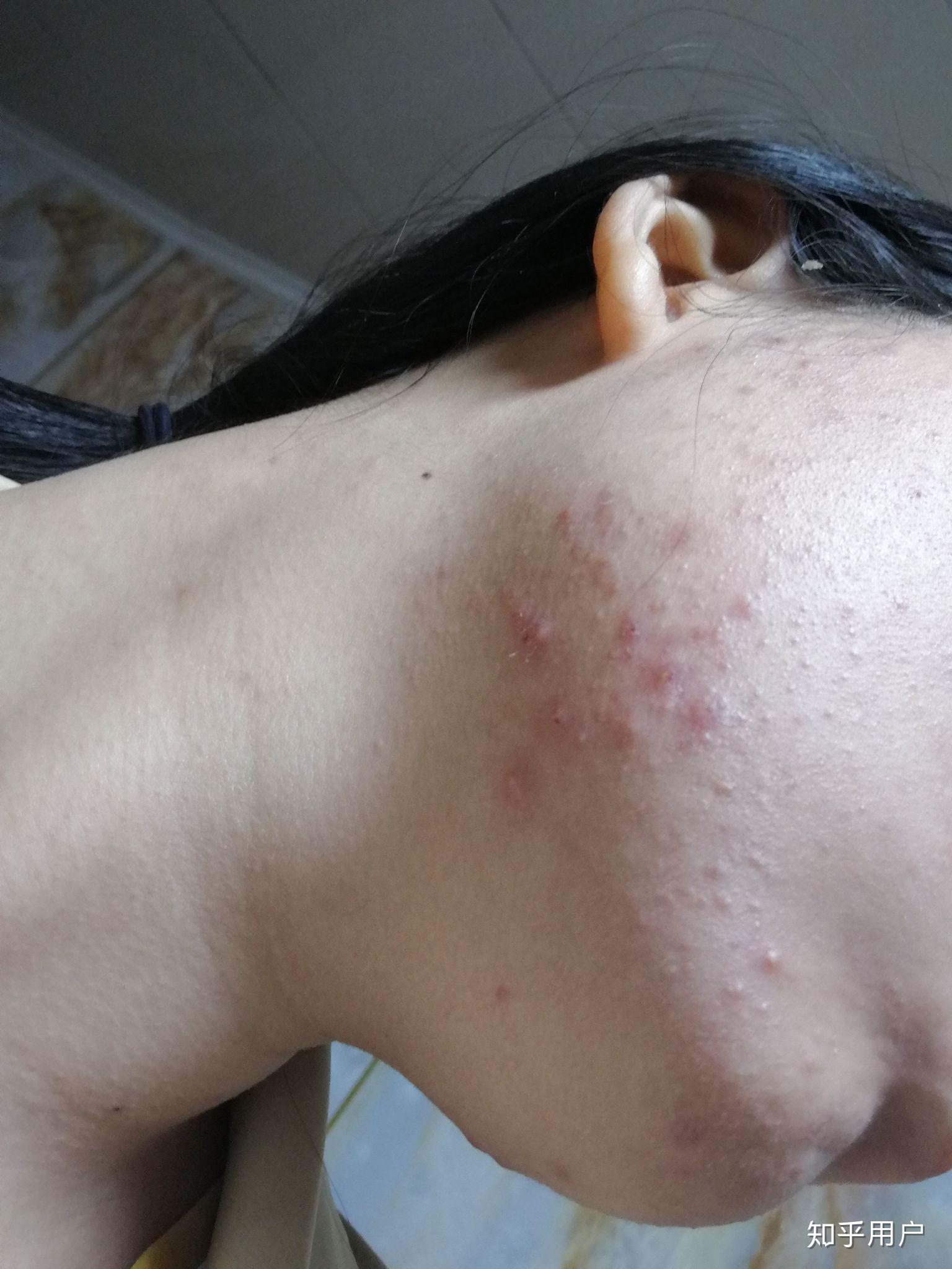 医院红光治疗对皮肤病究竟起什么作用,能不能把痘痘或者过敏症状治好