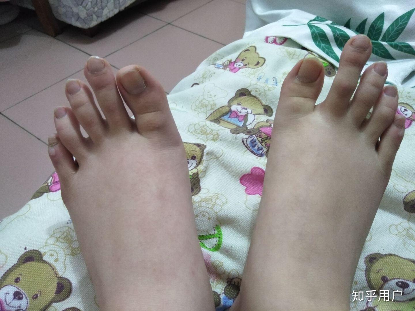 脚的二指头比大拇指长是什么样的感觉